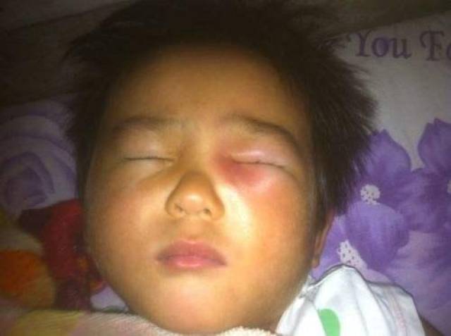 孩子眼睛红肿家人以为被蚊子咬的,到医院检查竟然是慢性病!