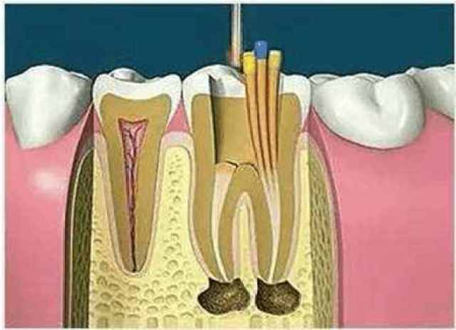 什么是牙齿打桩? 什么是根管治疗?