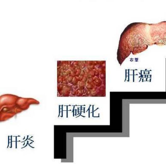 谁说肝癌来了不痛不痒不吭声?这5个早期信号不要傻傻的忽略了