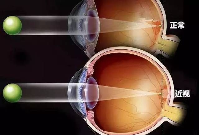 患近视眼的人看远处的东西,进入眼睛的光线不能聚焦在视网膜上,焦点落