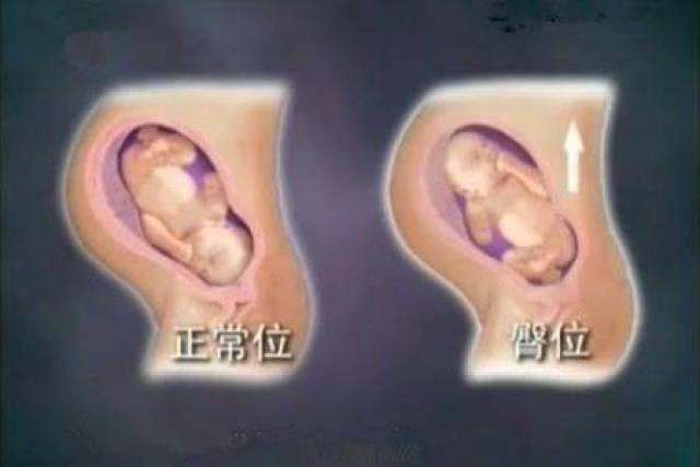二,胎位不正的,大家都知道顺产都是胎儿头部先出来,在临产前,医生会给