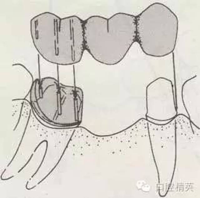 固定义齿修复之治疗步骤与术后问题的处理