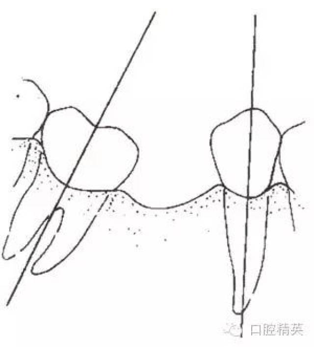 图4-15第二磨牙近中倾斜无共同就位道