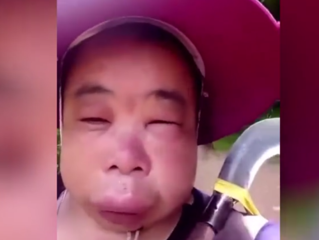 女子上山砍柴,被蜜蜂蜇成"猪头",不忘拍视频分享