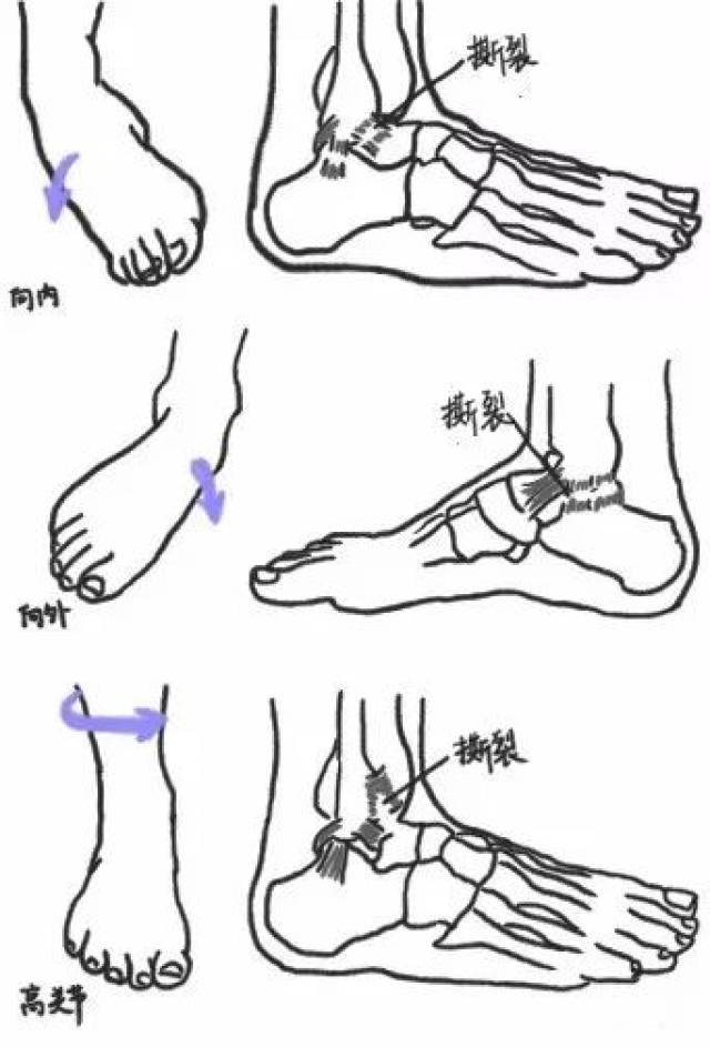 【见下图】 反复发生踝关节扭伤会导致关节结构不稳定,正常踝部运动