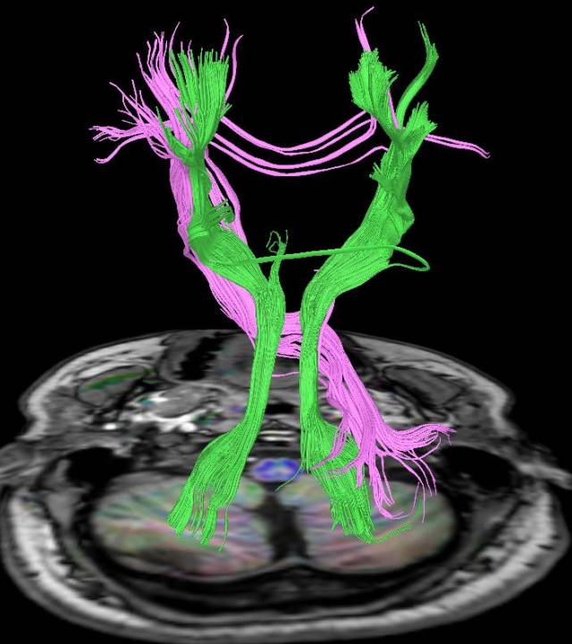 多彩大脑 首部《dti 神经纤维束(附培训教程视频)