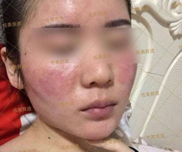 zome佐美良造-激素脸如何正确排毒,激素脸排毒最关键的三个步骤