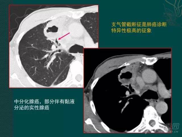 个人认为, 支气管截断征几乎是肺癌诊断中,特异性最高的征象.