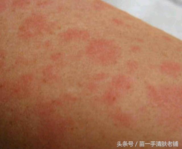这5种皮肤病在夏季高发,一定要及时注意!