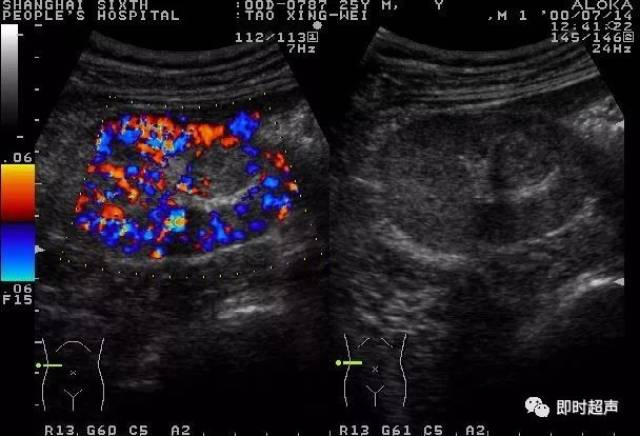 肾脏,输尿管疾病超声诊断