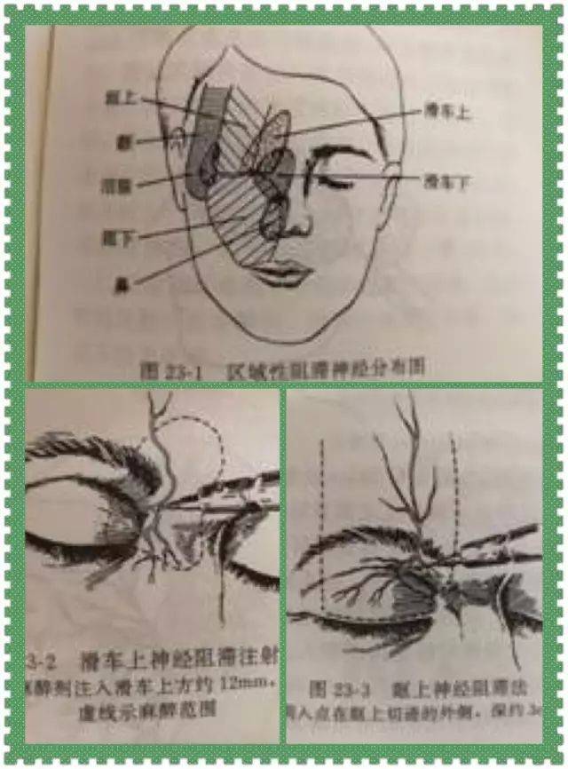 滑车上神经阻滞注射法,眶上神经阻滞法,泪腺神经注射术