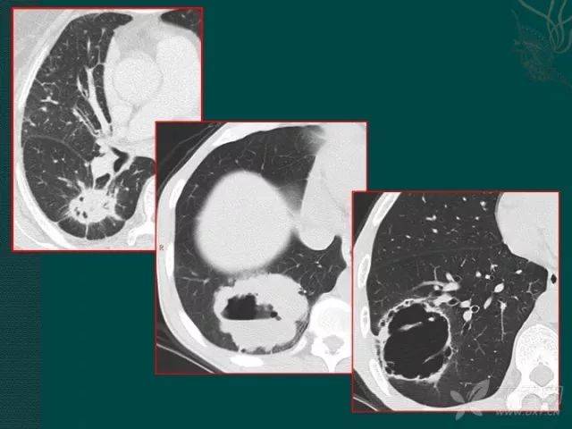 看完这篇,晋级空洞型肺癌诊断高手
