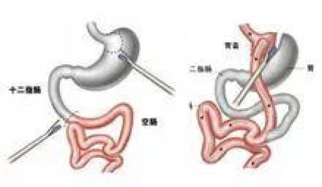 为了瘦,网红博主又切肠子又缩胃,结果.