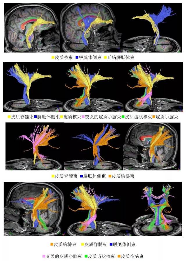 多彩大脑 首部《dti 神经纤维束(附培训教程视频)