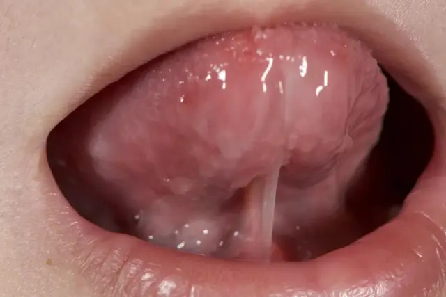 舌系带手术前