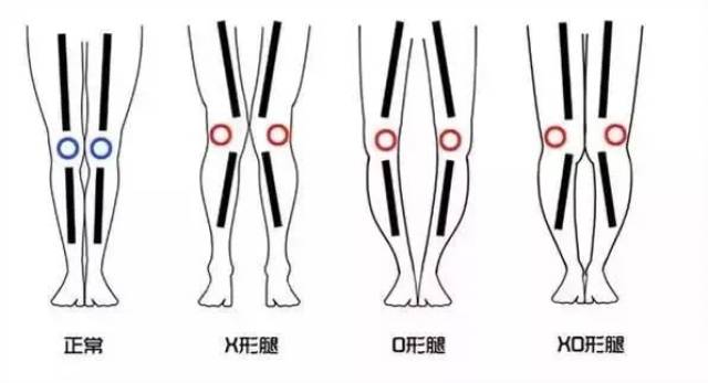 各种腿型问题一步解决!