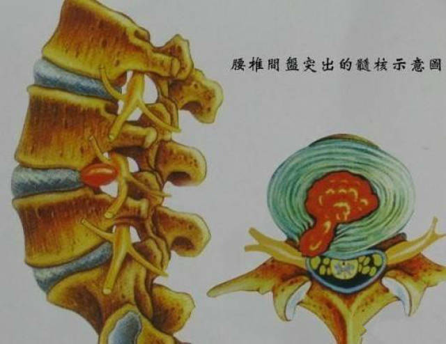 腰椎间盘突出会导致瘫痪吗?