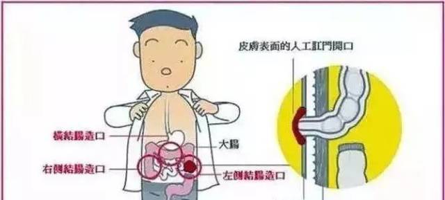 听听 西南医 大中医院国际造口治疗师巫玉兰怎么说?