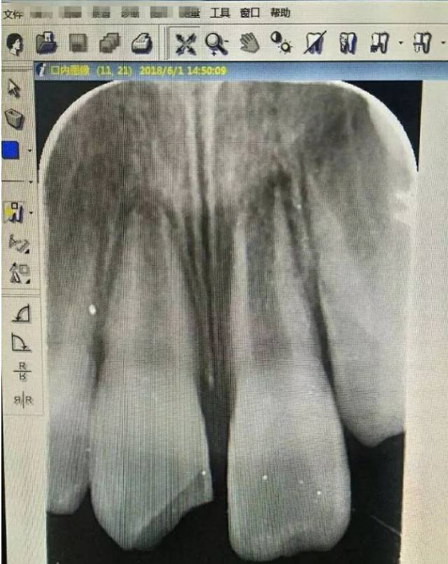 是牙根断裂,牙根断裂意思就是这牙已经没用了!