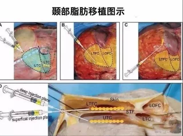 干货| 颞区脂肪室的应用解剖