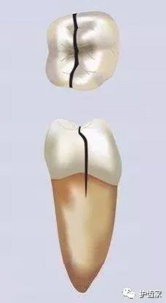 牙齿劈裂了怎么办?有哪些修复方法可以用?