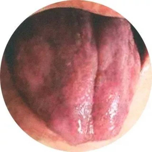 舌青紫,有瘀斑