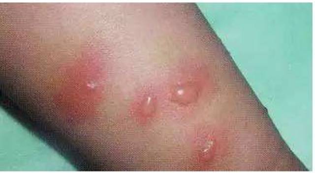 吸血蜱虫进入活跃期:孩子要防的不只是蚊子,还有这些会咬人的虫!