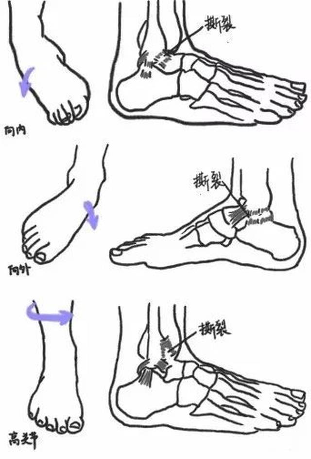 而踝关节扭伤通常都会伴有韧带的损伤,从而使踝关节的稳定性,平衡协调