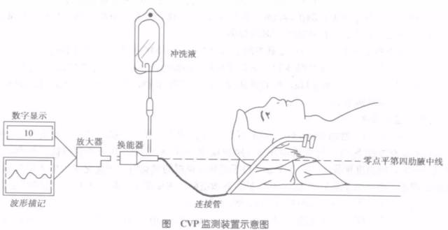 icu患者中心静脉压的测量与读取