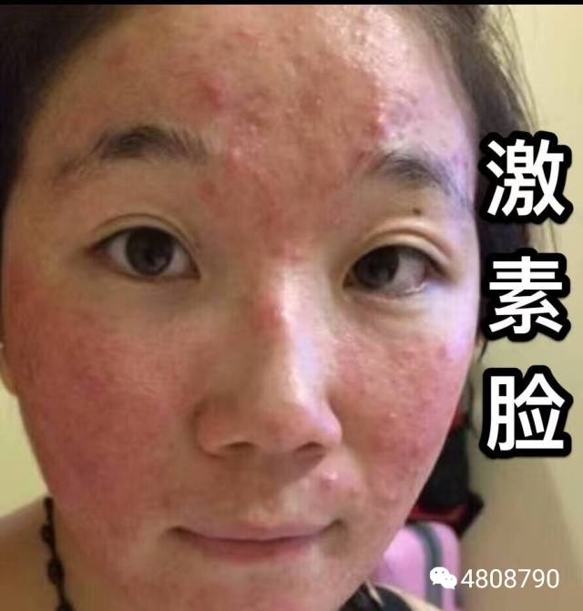 激素脸排毒说?到底有哪些毒?