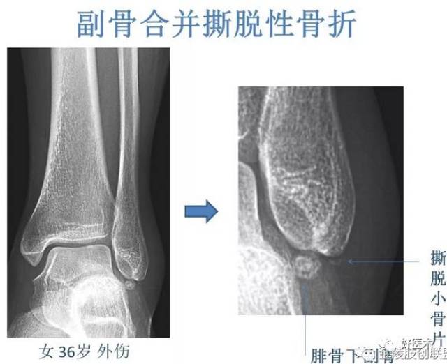 以下图的肱骨大结节撕脱性骨折为例, 总结下撕脱性骨折的影像学特征