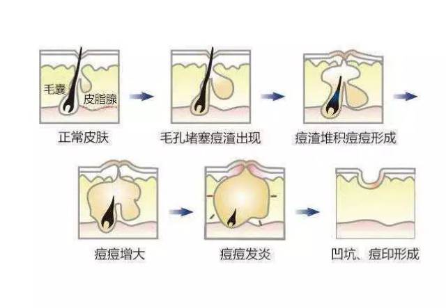 痘痘生长的4个阶段及祛除方法