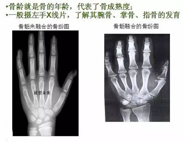 想知道孩子能长多高测一下骨龄就知道内含福利