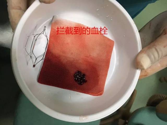 我院成功为下肢深静脉血栓患者开展下腔静脉滤器置入手术_手机搜狐网