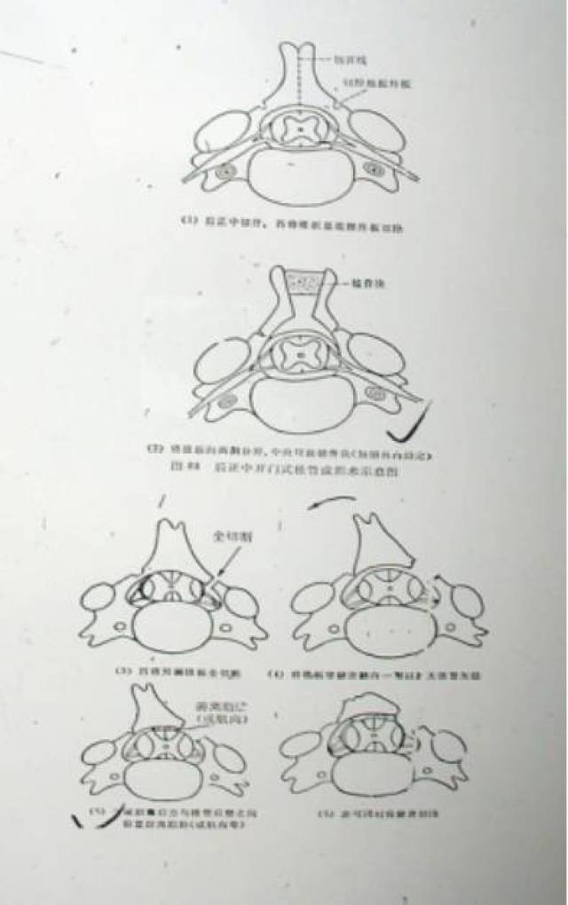 颈椎椎板成形术的适应症:发育性椎管狭窄(椎管矢状径在12mm以下者)