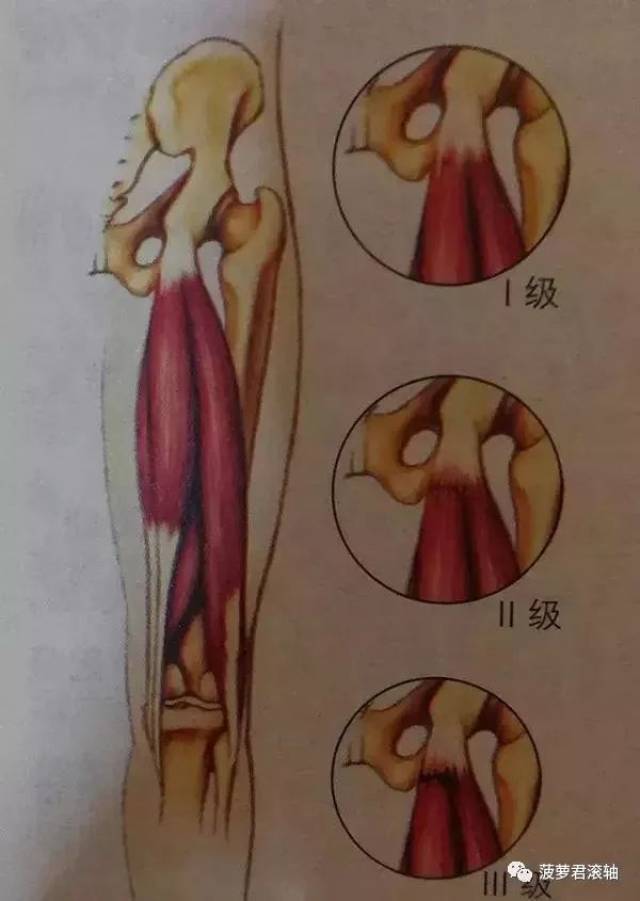 常可摸到肌与肌腱连接处略有缺失与下陷 三级:肌肉完全断裂,受伤时有