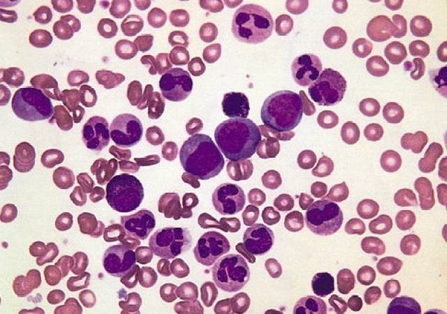 慢性粒细胞白血病慢性期外周血涂片|  患者会有哪些表现?