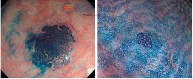 acf的内镜检查表现.a:亚甲蓝染色. b:放大观察.