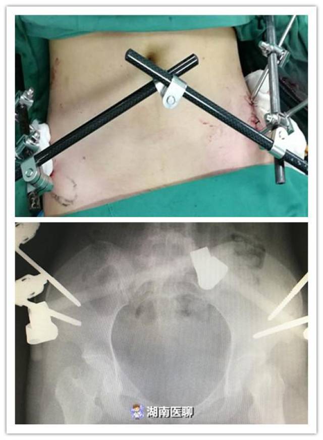 临床上一般骨盆前环不稳定骨折多以 外固定架或切开复位内固定手术为