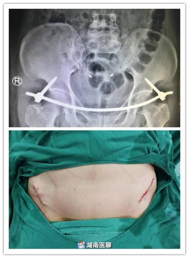55岁女子车祸骨盆骨折,手术后像"没事人"?仅腰上两个小口子
