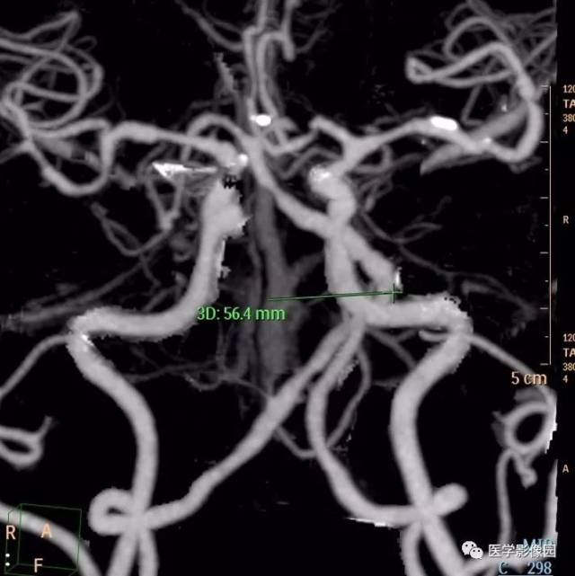 椎基底动脉延长扩张症,请你赏析 | 读片专栏828期