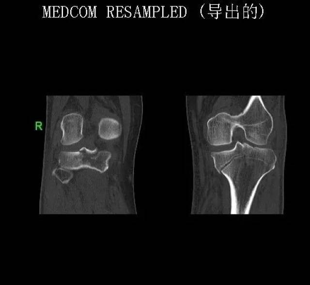 这个胫骨平台骨折刚刚做平片的时候患者正去做ct的路上,和主任争论了