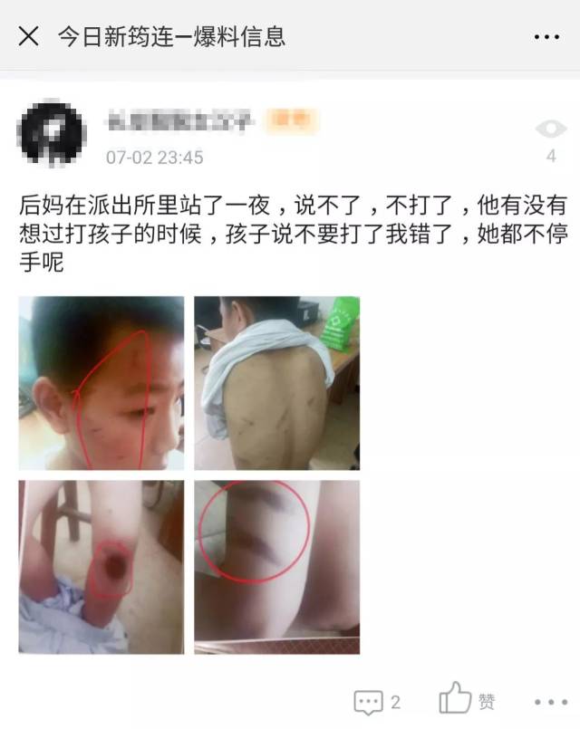 宜宾娃儿被后妈暴打,遍体鳞伤,全身伤痕累累