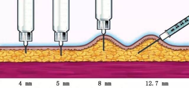 注射不同部位是否