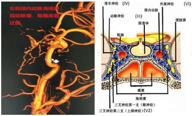 神经外三科成功完成经静脉岩下窦入路复杂海绵窦区硬脑膜动静脉瘘栓塞