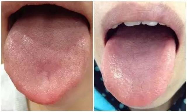 饮食,进补均有不同的方法 1 平和质 舌苔症状:舌淡红,苔薄白