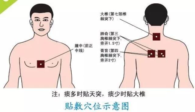 【微健康】冬病夏治"三伏贴"——慢性呼吸系统疾病患者的福音