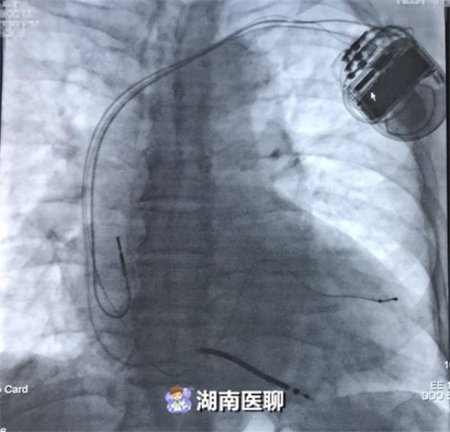 (三腔起搏器植入图) 结合患者病情,心内科蒲晓群教授,林佑谆副主任