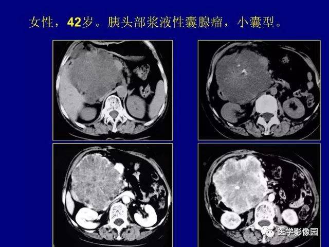 胰腺上皮样囊性肿瘤ct诊断分析 影像天地