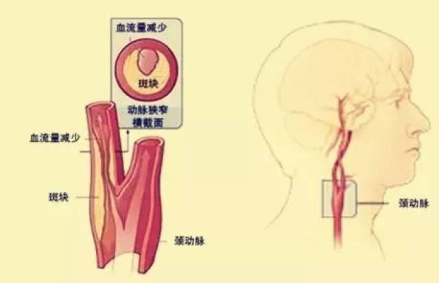 颈动脉斑块脱落